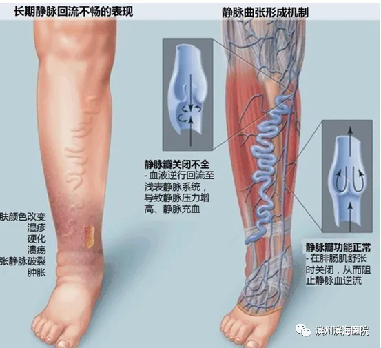 盘点静脉曲张高发人群有哪些?