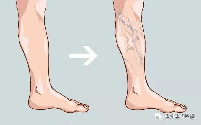 手术后怎样护理静脉曲张？