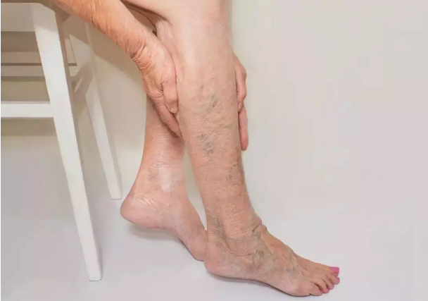 青筋隆起就是曲张征兆？到底怎么判断下肢静脉曲张呢