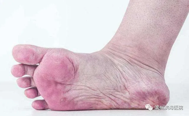 糖尿病足的早期症状和护理